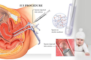 PHƯƠNG PHÁP IUI - BƠM TINH TRÙNG TRỰC TIẾP VÀO TỬ CUNG